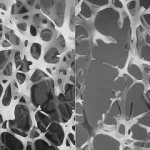 Left: normal bone, right: osteoporotic bone